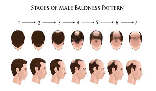 Reasons for Hair loss in men