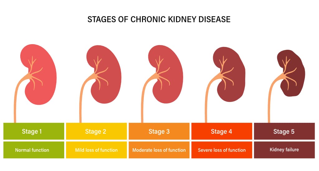 What Can Cause Chronic Kidney Disease?