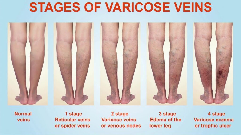 Varicose Veins