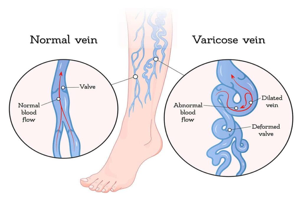 varicose veins3