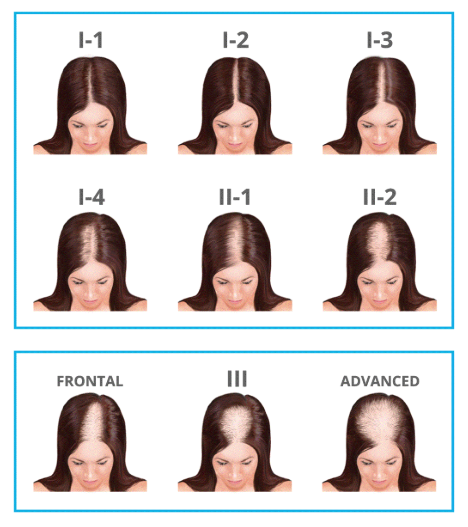 hair loss female