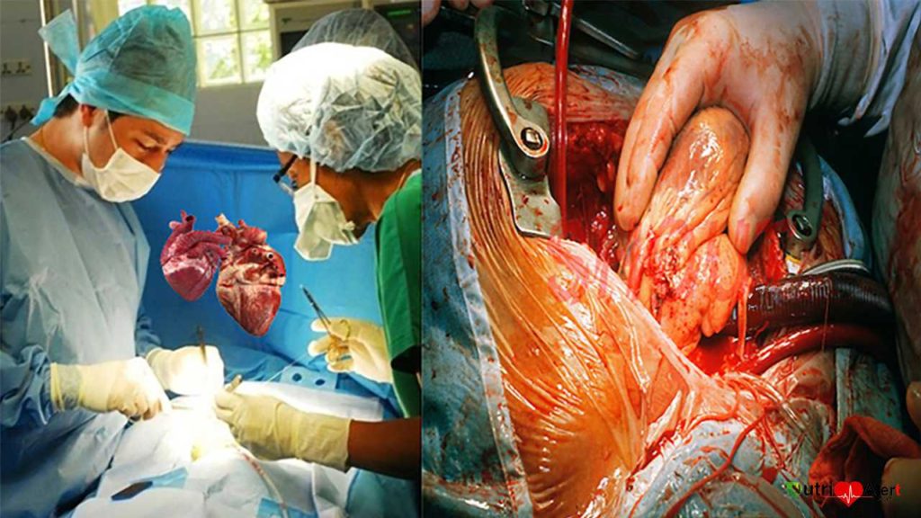 Piggyback Heart Transplant