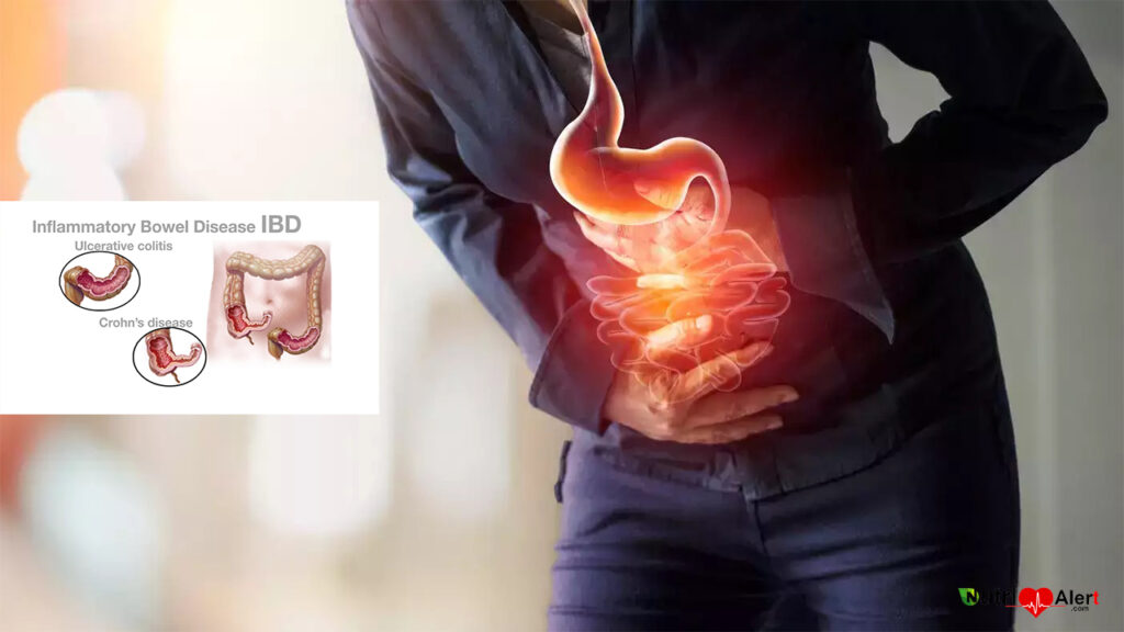 Inflammatory Bowel Disease