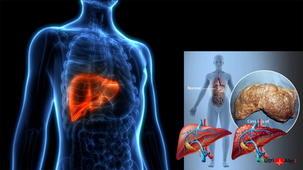 Liver cirrhosis Symptoms And Treatment